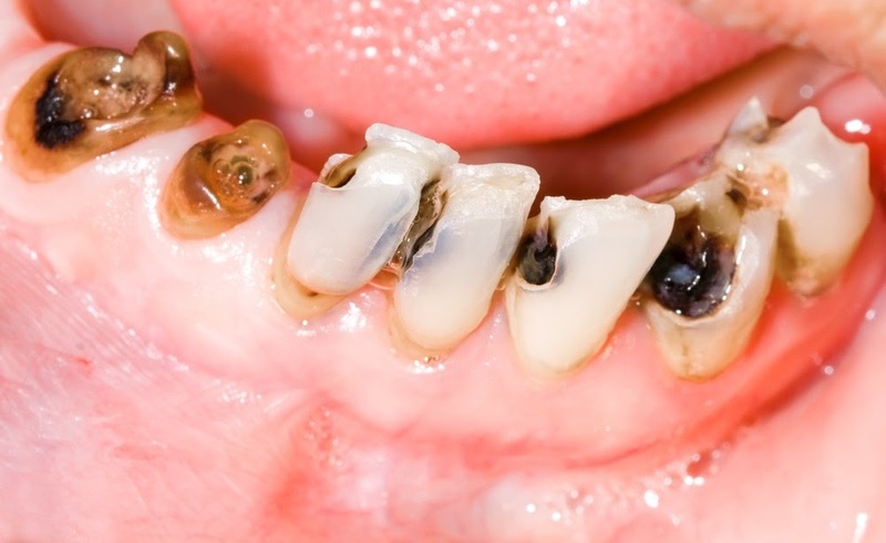 [CÓ HAY KHÔNG?] Mẹo chữa sâu răng từ dân gian hiệu quả