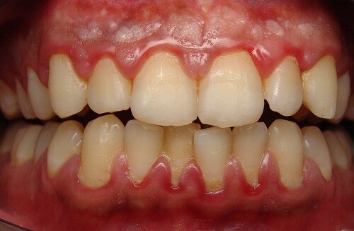 [ALO BÁC SĨ] Viêm nướu răng nổi hạch có nguy hiểm không?