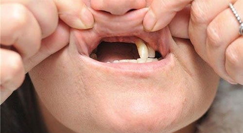 Cấy ghép răng cho người bị mất răng lâu năm