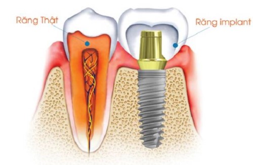 Mất răng hàm cấy ghép Implant phục hồi được không?